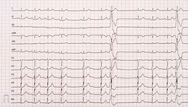 Tracciato del cuore