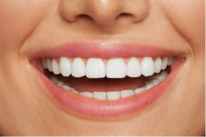 Sorriso denti bianchi